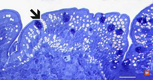 lipid malabsorption - large lipid droplets in enterocytes … semithin section lipid malabsorption - large lipid droplets in enterocytes … semithin section